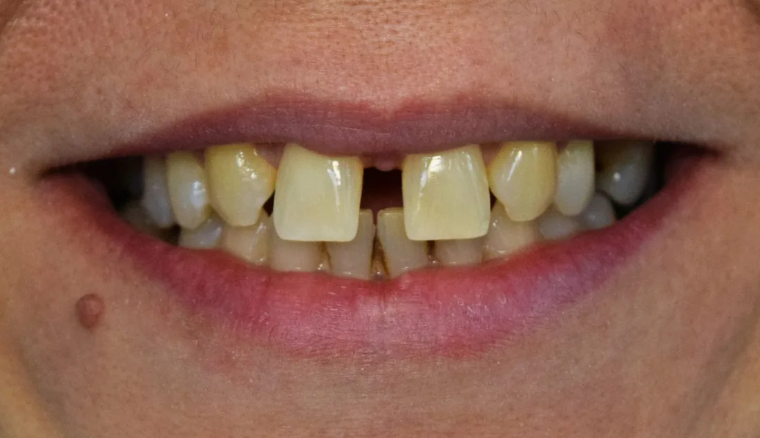 Pre
