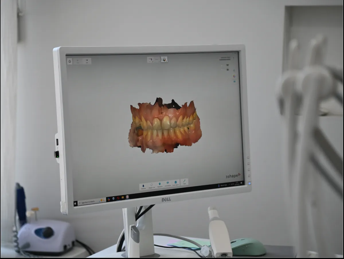 3D intraoralni skener – digitalni otisak