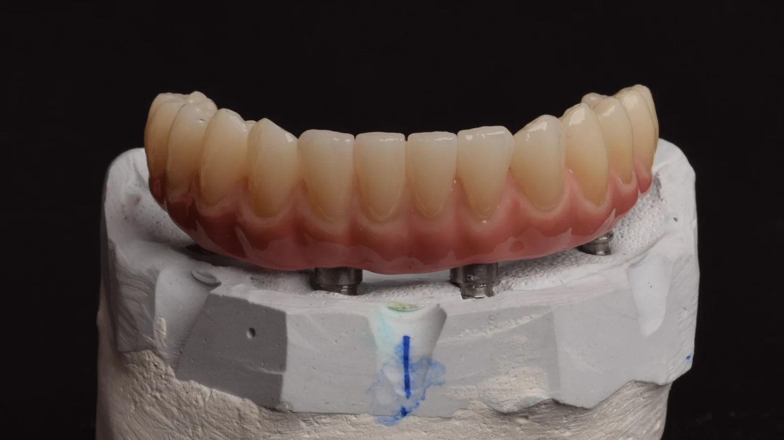 Prečka implantati 3
